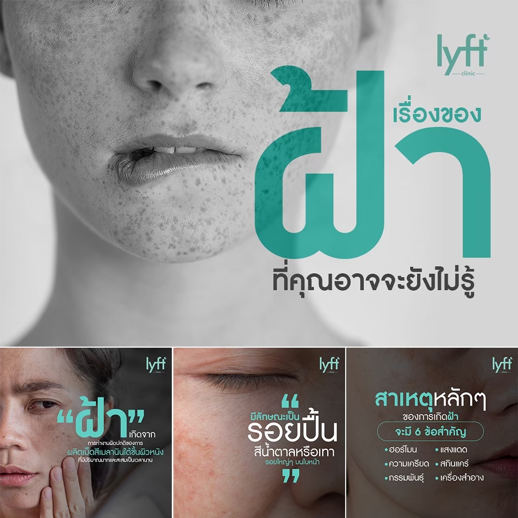 เมโสหน้าใส
