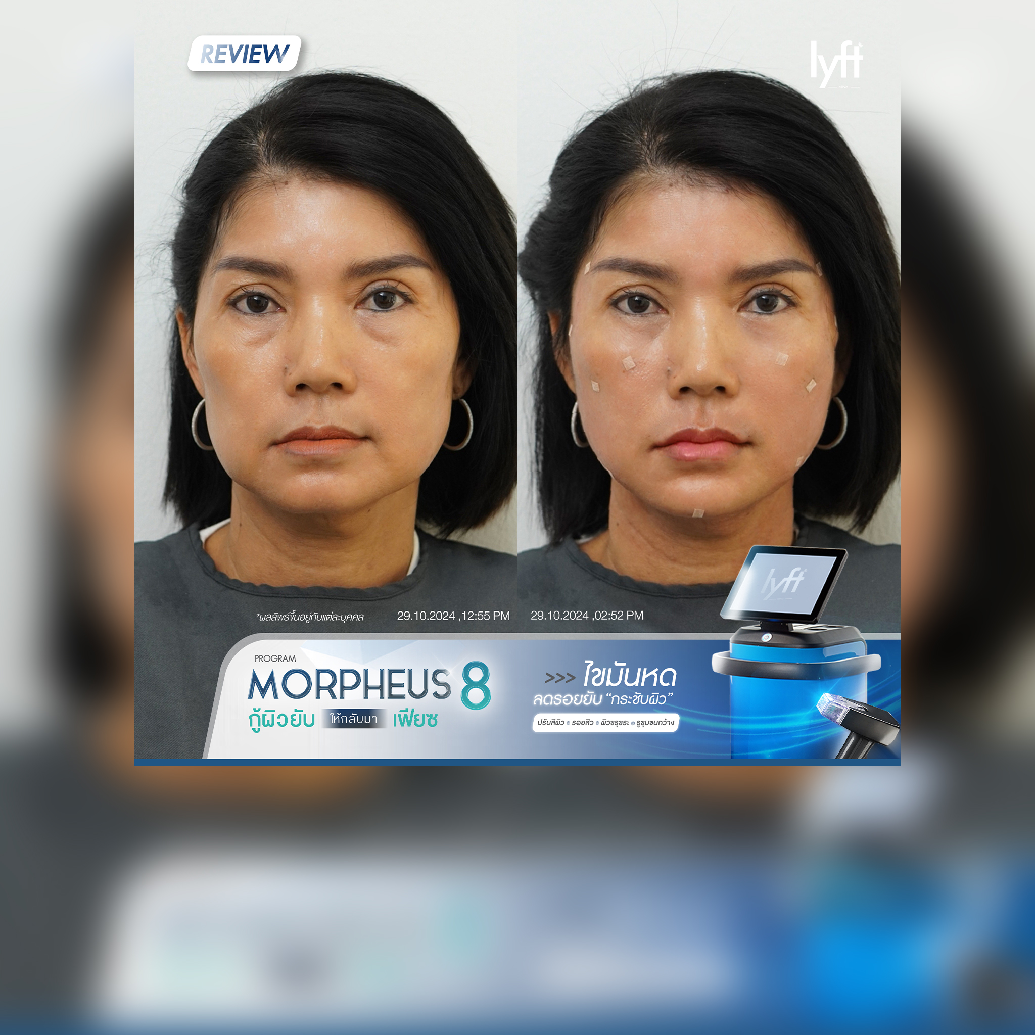 REVIEW หลังทำทันที Morpheus8