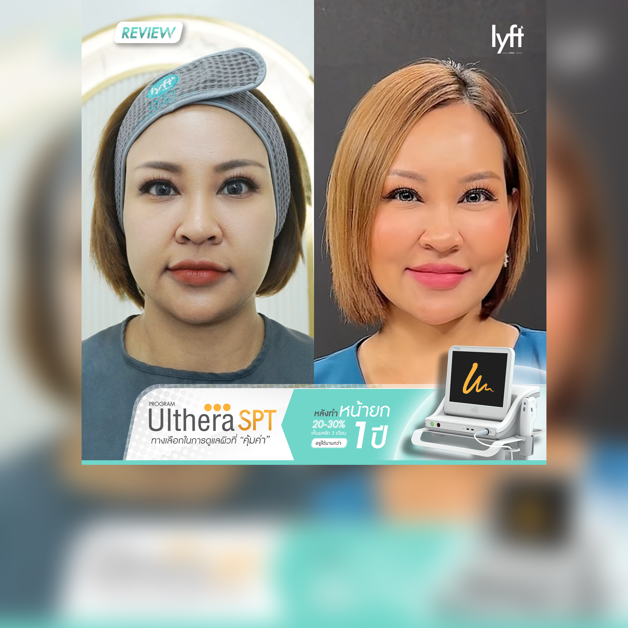 REVIEW UltheraSPT
